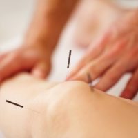 Closeup of woman's knee with acupuncture